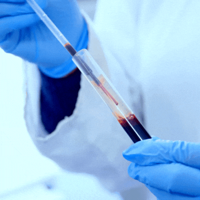 FDA aprova o primeiro exame de sangue para diagnóstico do Alzheimer
